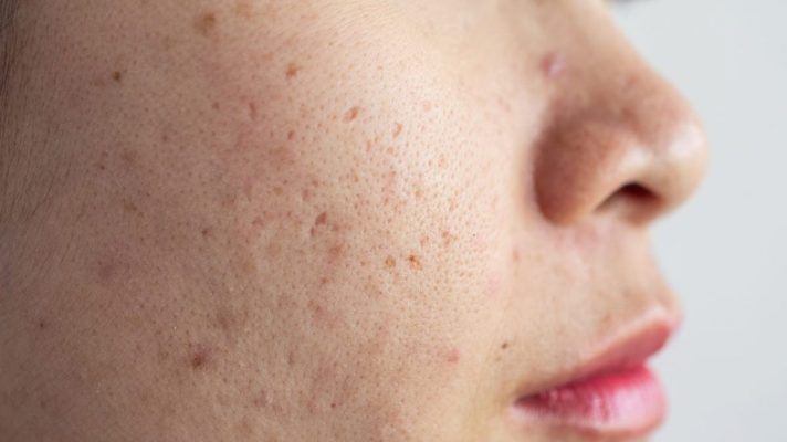 acne hyperpigmentation