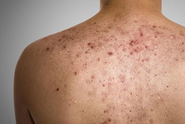back acne scar treatment